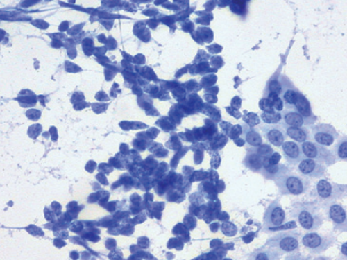 Epidémiologie des cancers en Ile-de-France